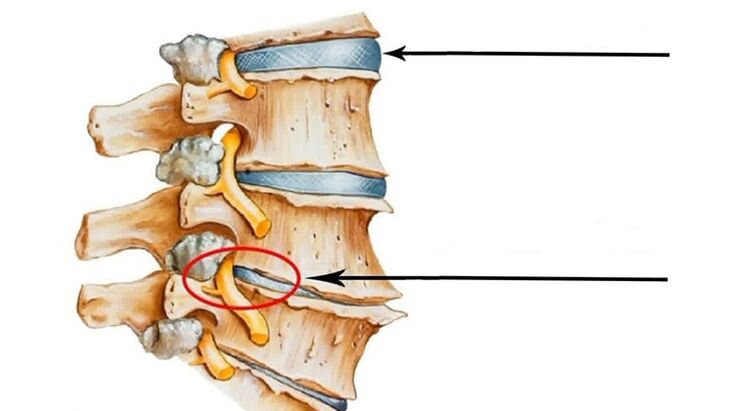 servikal osteokondroz durumunda spinal yaralanma