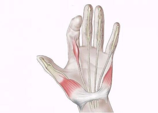 parmak eklemlerinde ağrı nedeni olarak tendon iltihabı