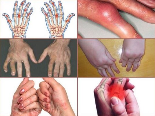parmak eklemlerinde ağrı