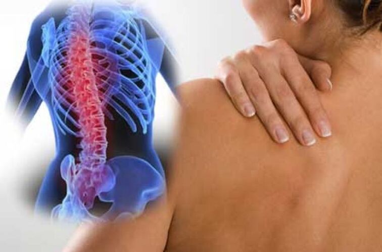 Torasik omurganın osteokondrozunun alevlenmesi sırasında dorsago ağrısı oluşur