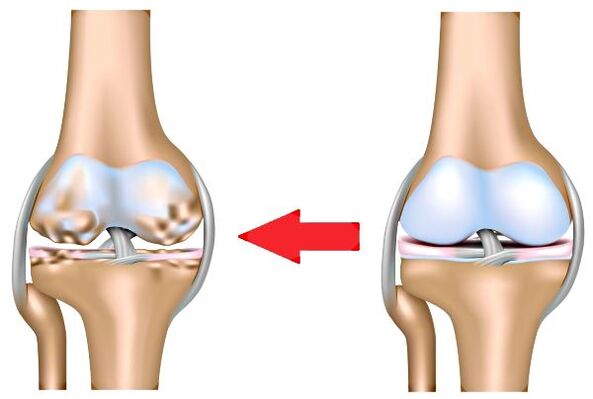 Sağlıklı Eklem ve Arthroz