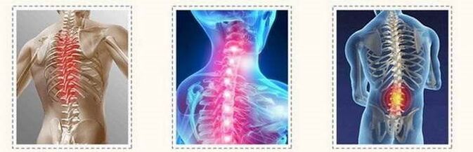 Osteokondroz spinal lezyonları
